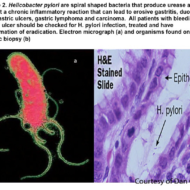 Refluks, kõrvetised, seedevaevused, nahaprobleemid, ärevus, Hashimoto tõbi jms autoimmuunhaigused, gastriit, mao- ja kaksteissõrmiksoole haavandid, maovähk on vaid mõned terviseprobleemid, mida kõrge immuunreaktiivsusega helikobakter tekitada ja süvendada võib. Tegu on tüütu spiroheediga, kes kruvib end mao või peensoole alguse limaskesta ja paneb seal püsti õdusa majapidamise, tekitades sellega põletikku, parietaalrakukahjustusi, häirides muu kõrval ka organismi mineraalide […]